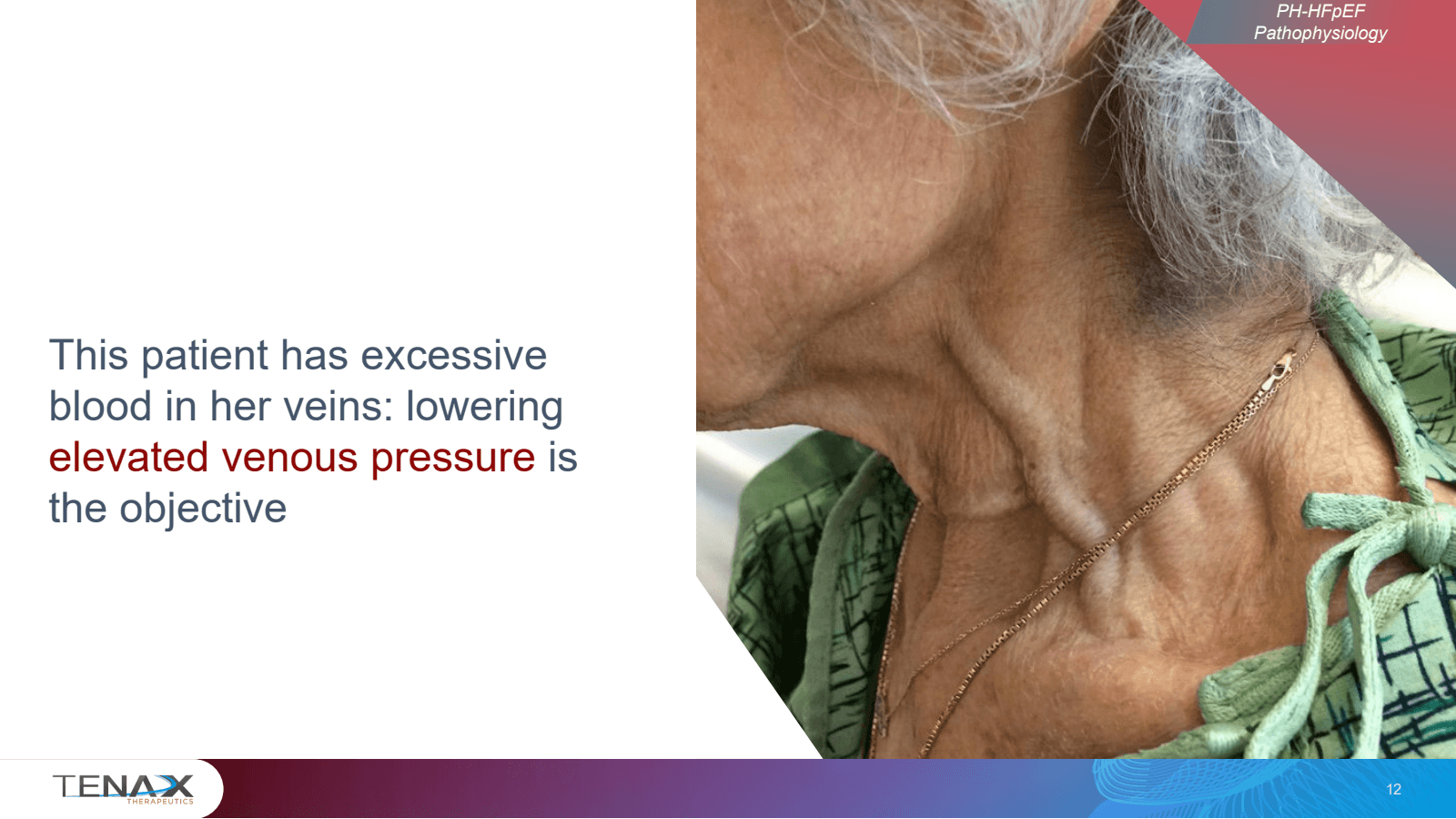 This patient has exc